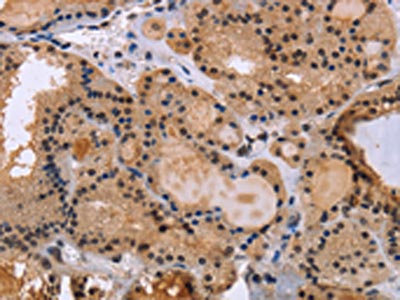 The image on the left is immunohistochemistry of paraffin-embedded Human thyroid cancer tissue using CSB-PA140670(KIF25 Antibody) at dilution 1/40, on the right is treated with fusion protein. (Original magnification: x200)