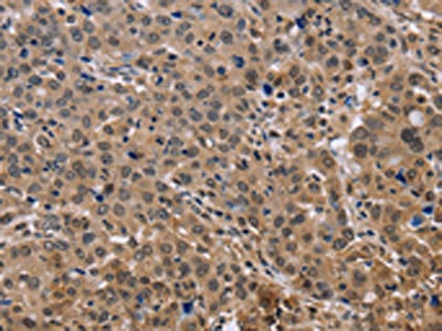 The image on the left is immunohistochemistry of paraffin-embedded Human liver cancer tissue using CSB-PA140670(KIF25 Antibody) at dilution 1/40, on the right is treated with fusion protein. (Original magnification: x200)