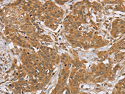 The image on the left is immunohistochemistry of paraffin-embedded Human cervical cancer tissue using CSB-PA141671(KCNJ15 Antibody) at dilution 1/40, on the right is treated with synthetic peptide. (Original magnification: x200)