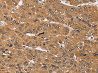 The image on the left is immunohistochemistry of paraffin-embedded Human liver cancer tissue using CSB-PA141671(KCNJ15 Antibody) at dilution 1/40, on the right is treated with synthetic peptide. (Original magnification: x200)