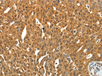 The image on the left is immunohistochemistry of paraffin-embedded Human ovarian cancer tissue using CSB-PA143745(SIRT4 Antibody) at dilution 1/25, on the right is treated with fusion protein. (Original magnification: x200)