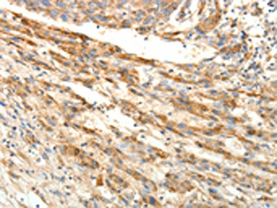 The image on the left is immunohistochemistry of paraffin-embedded Human liver cancer tissue using CSB-PA143745(SIRT4 Antibody) at dilution 1/25, on the right is treated with fusion protein. (Original magnification: x200)