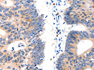 The image on the left is immunohistochemistry of paraffin-embedded Human colon cancer tissue using CSB-PA145350(LAT2 Antibody) at dilution 1/15, on the right is treated with fusion protein. (Original magnification: x200)