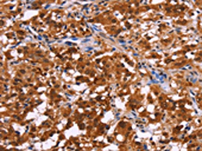 The image on the left is immunohistochemistry of paraffin-embedded Human thyroid cancer tissue using CSB-PA155084(USP2 Antibody) at dilution 1/40, on the right is treated with fusion protein. (Original magnification: x200)