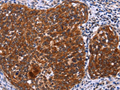 The image on the left is immunohistochemistry of paraffin-embedded Human cervical cancer tissue using CSB-PA155084(USP2 Antibody) at dilution 1/40, on the right is treated with fusion protein. (Original magnification: x200)