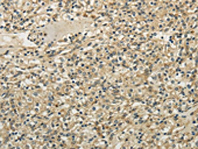 The image on the left is immunohistochemistry of paraffin-embedded Human prostate cancer tissue using CSB-PA159160(TULP2 Antibody) at dilution 1/30, on the right is treated with fusion protein. (Original magnification: x200)