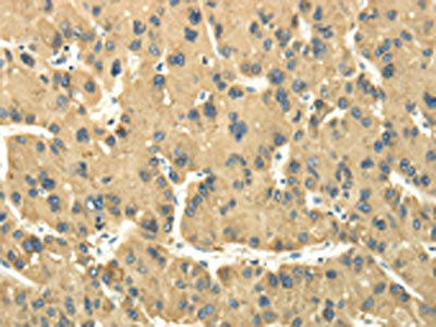 The image on the left is immunohistochemistry of paraffin-embedded Human liver cancer tissue using CSB-PA159160(TULP2 Antibody) at dilution 1/30, on the right is treated with fusion protein. (Original magnification: x200)