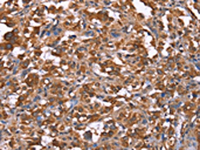 The image on the left is immunohistochemistry of paraffin-embedded Human thyroid cancer tissue using CSB-PA159201(HRASLS2 Antibody) at dilution 1/40, on the right is treated with synthetic peptide. (Original magnification: x200)