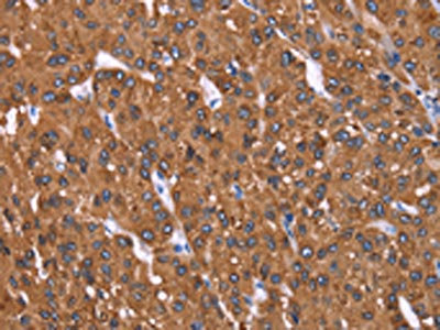 The image on the left is immunohistochemistry of paraffin-embedded Human liver cancer tissue using CSB-PA159201(HRASLS2 Antibody) at dilution 1/40, on the right is treated with synthetic peptide. (Original magnification: x200) The image on the left is immunohistochemistry of paraffin-embedded Human liver cancer tissue using CSB-PA159201(HRASLS2 Antibody) at dilution 1/40, on the right is treated with synthetic peptide. (Original magnification: x200)