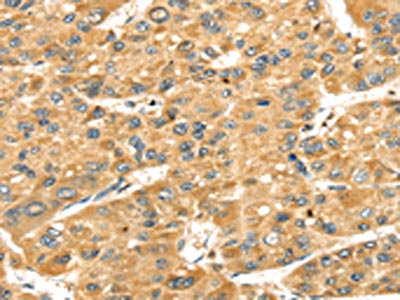 The image on the left is immunohistochemistry of paraffin-embedded Human liver cancer tissue using CSB-PA160205(SH3KBP1 Antibody) at dilution 1/40, on the right is treated with fusion protein. (Original magnification: x200) The image on the left is immunohistochemistry of paraffin-embedded Human liver cancer tissue using CSB-PA160205(SH3KBP1 Antibody) at dilution 1/40, on the right is treated with fusion protein. (Original magnification: x200)