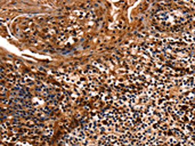 The image on the left is immunohistochemistry of paraffin-embedded Human tonsil tissue using CSB-PA160863(HSPD1 Antibody) at dilution 1/12, on the right is treated with fusion protein. (Original magnification: x200)