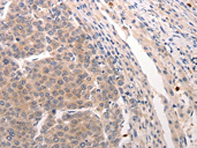 The image on the left is immunohistochemistry of paraffin-embedded Human breast cancer tissue using CSB-PA160889(CDC37 Antibody) at dilution 1/20, on the right is treated with synthetic peptide. (Original magnification: x200)