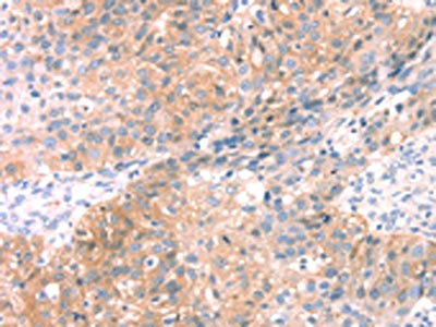 The image on the left is immunohistochemistry of paraffin-embedded Human breast cancer tissue using CSB-PA161006(SNAP23 Antibody) at dilution 1/25, on the right is treated with fusion protein. (Original magnification: x200)