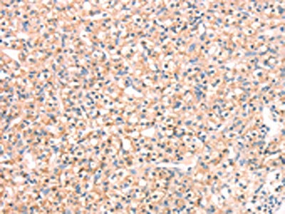 The image on the left is immunohistochemistry of paraffin-embedded Human prostate cancer tissue using CSB-PA161006(SNAP23 Antibody) at dilution 1/25, on the right is treated with fusion protein. (Original magnification: x200) The image on the left is immunohistochemistry of paraffin-embedded Human prostate cancer tissue using CSB-PA161006(SNAP23 Antibody) at dilution 1/25, on the right is treated with fusion protein. (Original magnification: x200)