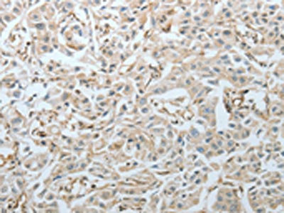 The image on the left is immunohistochemistry of paraffin-embedded Human lung cancer tissue using CSB-PA161781(CRMP1 Antibody) at dilution 1/20, on the right is treated with fusion protein. (Original magnification: x200)