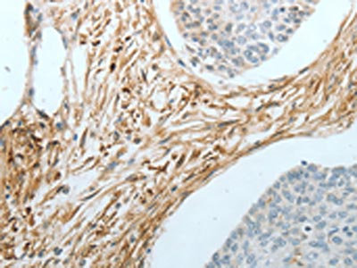 The image on the left is immunohistochemistry of paraffin-embedded Human cervical cancer tissue using CSB-PA161781(CRMP1 Antibody) at dilution 1/20, on the right is treated with fusion protein. (Original magnification: x200)