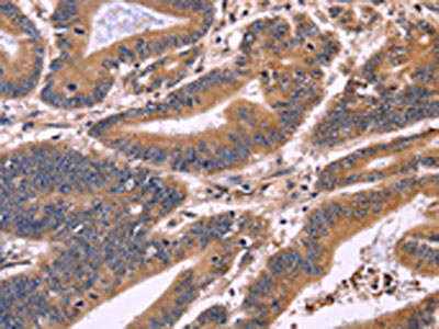 The image on the left is immunohistochemistry of paraffin-embedded Human colon cancer tissue using CSB-PA165136(S100A13 Antibody) at dilution 1/40, on the right is treated with fusion protein. (Original magnification: x200)