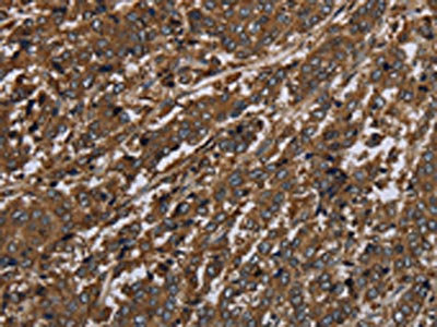The image on the left is immunohistochemistry of paraffin-embedded Human liver cancer tissue using CSB-PA166476(HPGD Antibody) at dilution 1/30, on the right is treated with fusion protein. (Original magnification: x200)