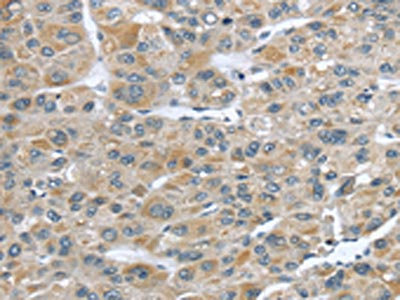 The image on the left is immunohistochemistry of paraffin-embedded Human liver cancer tissue using CSB-PA172691(CFAP45 Antibody) at dilution 1/25, on the right is treated with synthetic peptide. (Original magnification: x200)