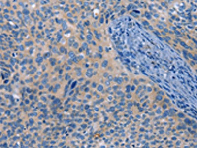 The image on the left is immunohistochemistry of paraffin-embedded Human cervical cancer tissue using CSB-PA173019(MAP2K1 Antibody) at dilution 1/25, on the right is treated with fusion protein. (Original magnification: x200)