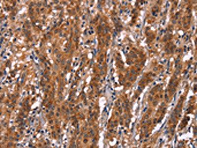 The image on the left is immunohistochemistry of paraffin-embedded Human gastric cancer tissue using CSB-PA173468(GPHN Antibody) at dilution 1/30, on the right is treated with synthetic peptide. (Original magnification: x200)