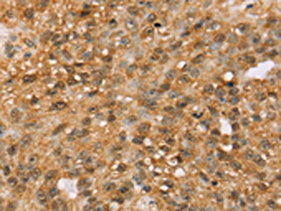 The image on the left is immunohistochemistry of paraffin-embedded Human breast cancer tissue using CSB-PA187654(MED22 Antibody) at dilution 1/50, on the right is treated with fusion protein. (Original magnification: x200)