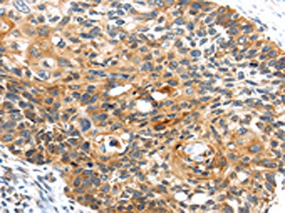 The image on the left is immunohistochemistry of paraffin-embedded Human esophagus cancer tissue using CSB-PA189699(CENPM Antibody) at dilution 1/30, on the right is treated with fusion protein. (Original magnification: x200)
