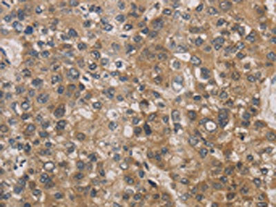 The image on the left is immunohistochemistry of paraffin-embedded Human liver cancer tissue using CSB-PA191736(DEGS1 Antibody) at dilution 1/30, on the right is treated with fusion protein. (Original magnification: x200)