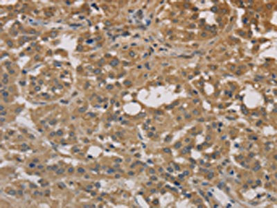The image on the left is immunohistochemistry of paraffin-embedded Human thyroid cancer tissue using CSB-PA191736(DEGS1 Antibody) at dilution 1/30, on the right is treated with fusion protein. (Original magnification: x200)