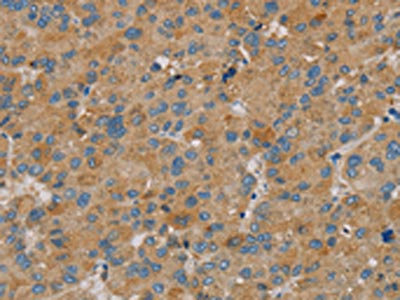 The image on the left is immunohistochemistry of paraffin-embedded Human liver cancer tissue using CSB-PA193064(PARL Antibody) at dilution 1/20, on the right is treated with fusion protein. (Original magnification: x200)