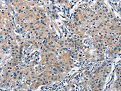 The image on the left is immunohistochemistry of paraffin-embedded Human gastric cancer tissue using CSB-PA193346(TRIP4 Antibody) at dilution 1/50, on the right is treated with fusion protein. (Original magnification: x200)