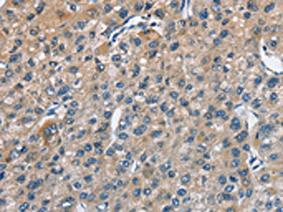 The image on the left is immunohistochemistry of paraffin-embedded Human liver cancer tissue using CSB-PA193346(TRIP4 Antibody) at dilution 1/50, on the right is treated with fusion protein. (Original magnification: x200) The image on the left is immunohistochemistry of paraffin-embedded Human liver cancer tissue using CSB-PA193346(TRIP4 Antibody) at dilution 1/50, on the right is treated with fusion protein. (Original magnification: x200)