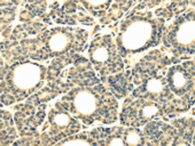 The image on the left is immunohistochemistry of paraffin-embedded Human thyroid cancer tissue using CSB-PA195244(WDR45B Antibody) at dilution 1/40, on the right is treated with synthetic peptide. (Original magnification: x200)