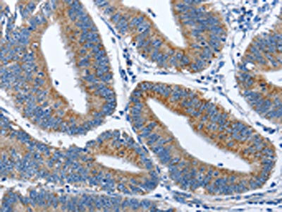 The image on the left is immunohistochemistry of paraffin-embedded Human colon cancer tissue using CSB-PA195475(CADM3 Antibody) at dilution 1/40, on the right is treated with fusion protein. (Original magnification: x200)