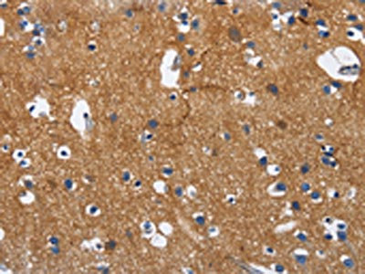 The image on the left is immunohistochemistry of paraffin-embedded Human brain tissue using CSB-PA195475(CADM3 Antibody) at dilution 1/40, on the right is treated with fusion protein. (Original magnification: x200) The image on the left is immunohistochemistry of paraffin-embedded Human brain tissue using CSB-PA195475(CADM3 Antibody) at dilution 1/40, on the right is treated with fusion protein. (Original magnification: x200)