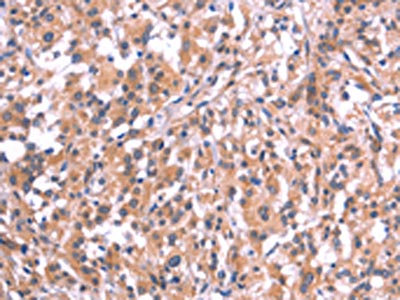 The image on the left is immunohistochemistry of paraffin-embedded Human thyroid cancer tissue using CSB-PA196695(EMP2 Antibody) at dilution 1/20, on the right is treated with synthetic peptide. (Original magnification: x200)