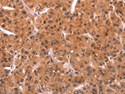 The image on the left is immunohistochemistry of paraffin-embedded Human liver cancer tissue using CSB-PA196695(EMP2 Antibody) at dilution 1/20, on the right is treated with synthetic peptide. (Original magnification: x200)