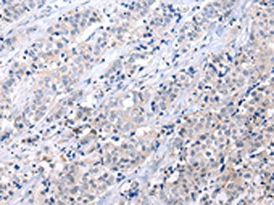 The image on the left is immunohistochemistry of paraffin-embedded Human breast cancer tissue using CSB-PA197802(ATF6 Antibody) at dilution 1/25, on the right is treated with synthetic peptide. (Original magnification: x200)