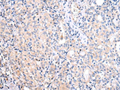 The image on the left is immunohistochemistry of paraffin-embedded Human thyroid cancer tissue using CSB-PA197802(ATF6 Antibody) at dilution 1/25, on the right is treated with synthetic peptide. (Original magnification: x200) The image on the left is immunohistochemistry of paraffin-embedded Human thyroid cancer tissue using CSB-PA197802(ATF6 Antibody) at dilution 1/25, on the right is treated with synthetic peptide. (Original magnification: x200)