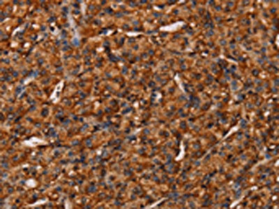 The image on the left is immunohistochemistry of paraffin-embedded Human prostate cancer tissue using CSB-PA199023(COL18A1 Antibody) at dilution 1/40, on the right is treated with synthetic peptide. (Original magnification: x200) The image on the left is immunohistochemistry of paraffin-embedded Human prostate cancer tissue using CSB-PA199023(COL18A1 Antibody) at dilution 1/40, on the right is treated with synthetic peptide. (Original magnification: x200)