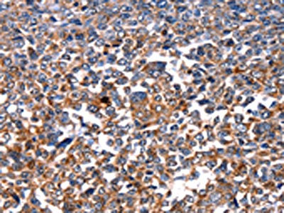 The image on the left is immunohistochemistry of paraffin-embedded Human ovarian cancer tissue using CSB-PA199595(HSPD1 Antibody) at dilution 1/15, on the right is treated with fusion protein. (Original magnification: x200)