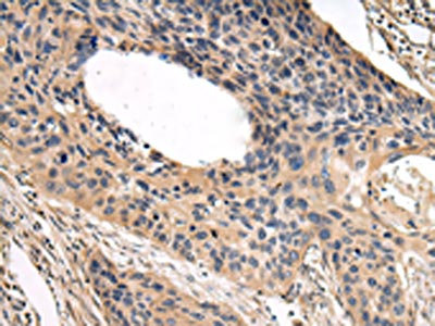 The image on the left is immunohistochemistry of paraffin-embedded Human esophagus cancer tissue using CSB-PA200282(USP15 Antibody) at dilution 1/35, on the right is treated with fusion protein. (Original magnification: x200) The image on the left is immunohistochemistry of paraffin-embedded Human esophagus cancer tissue using CSB-PA200282(USP15 Antibody) at dilution 1/35, on the right is treated with fusion protein. (Original magnification: x200)
