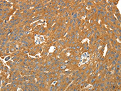 The image on the left is immunohistochemistry of paraffin-embedded Human ovarian cancer tissue using CSB-PA201090(SIRT4 Antibody) at dilution 1/25. (Original magnification: x200)
