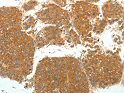 The image on the left is immunohistochemistry of paraffin-embedded Human liver cancer tissue using CSB-PA201090(SIRT4 Antibody) at dilution 1/25. (Original magnification: x200)