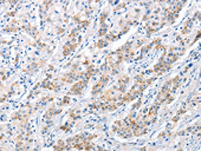 The image on the left is immunohistochemistry of paraffin-embedded Human gastric cancer tissue using CSB-PA203103(PAPSS1 Antibody) at dilution 1/40, on the right is treated with fusion protein. (Original magnification: x200)