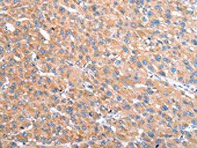 The image on the left is immunohistochemistry of paraffin-embedded Human liver cancer tissue using CSB-PA203811(VPS16 Antibody) at dilution 1/35, on the right is treated with fusion protein. (Original magnification: x200)