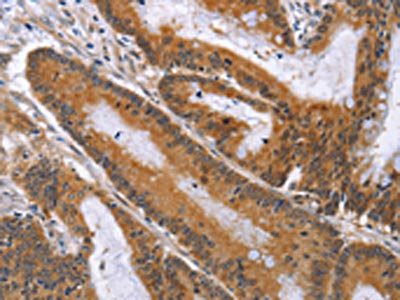 The image on the left is immunohistochemistry of paraffin-embedded Human colon cancer tissue using CSB-PA206692(ACVR2B Antibody) at dilution 1/50, on the right is treated with fusion protein. (Original magnification: x200)