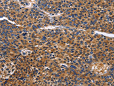 The image on the left is immunohistochemistry of paraffin-embedded Human liver cancer tissue using CSB-PA206692(ACVR2B Antibody) at dilution 1/50, on the right is treated with fusion protein. (Original magnification: x200)