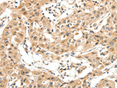 The image on the left is immunohistochemistry of paraffin-embedded Human lung cancer tissue using CSB-PA206897(MAP3K14 Antibody) at dilution 1/20, on the right is treated with fusion protein. (Original magnification: x200)