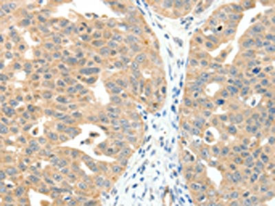 The image on the left is immunohistochemistry of paraffin-embedded Human ovarian cancer tissue using CSB-PA206897(MAP3K14 Antibody) at dilution 1/20, on the right is treated with fusion protein. (Original magnification: x200)